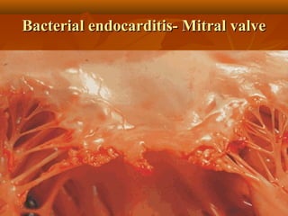 Bacterial endocarditis- Mitral valveBacterial endocarditis- Mitral valve
 