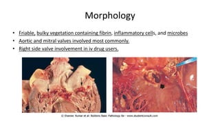 Morphology
• Friable, bulky vegetation containing fibrin, inflammatory cells, and microbes
• Aortic and mitral valves involved most commonly.
• Right side valve involvement in iv drug users.
 
