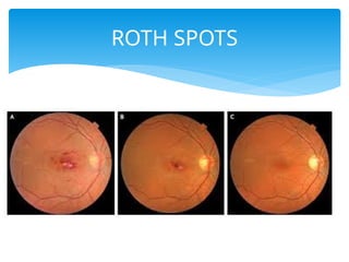 INFECTIVE ENDOCARDITIS 600L.pptx thhedwhgd | PPTX