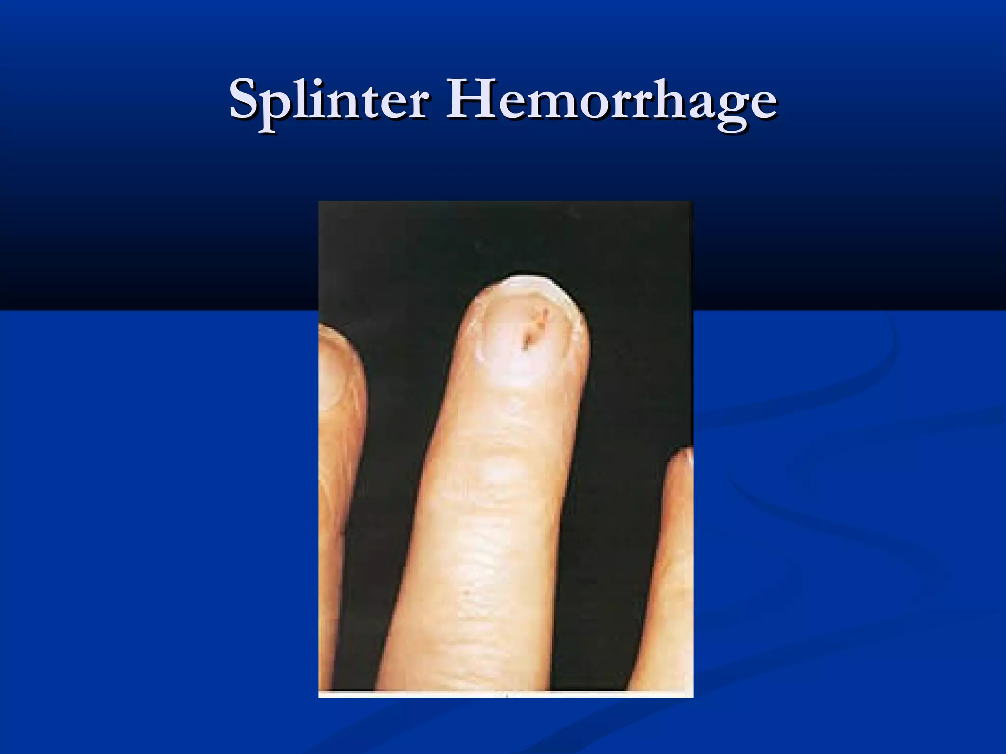 SSpplliinntteerr HHeemmoorrrrhhaaggee 
 