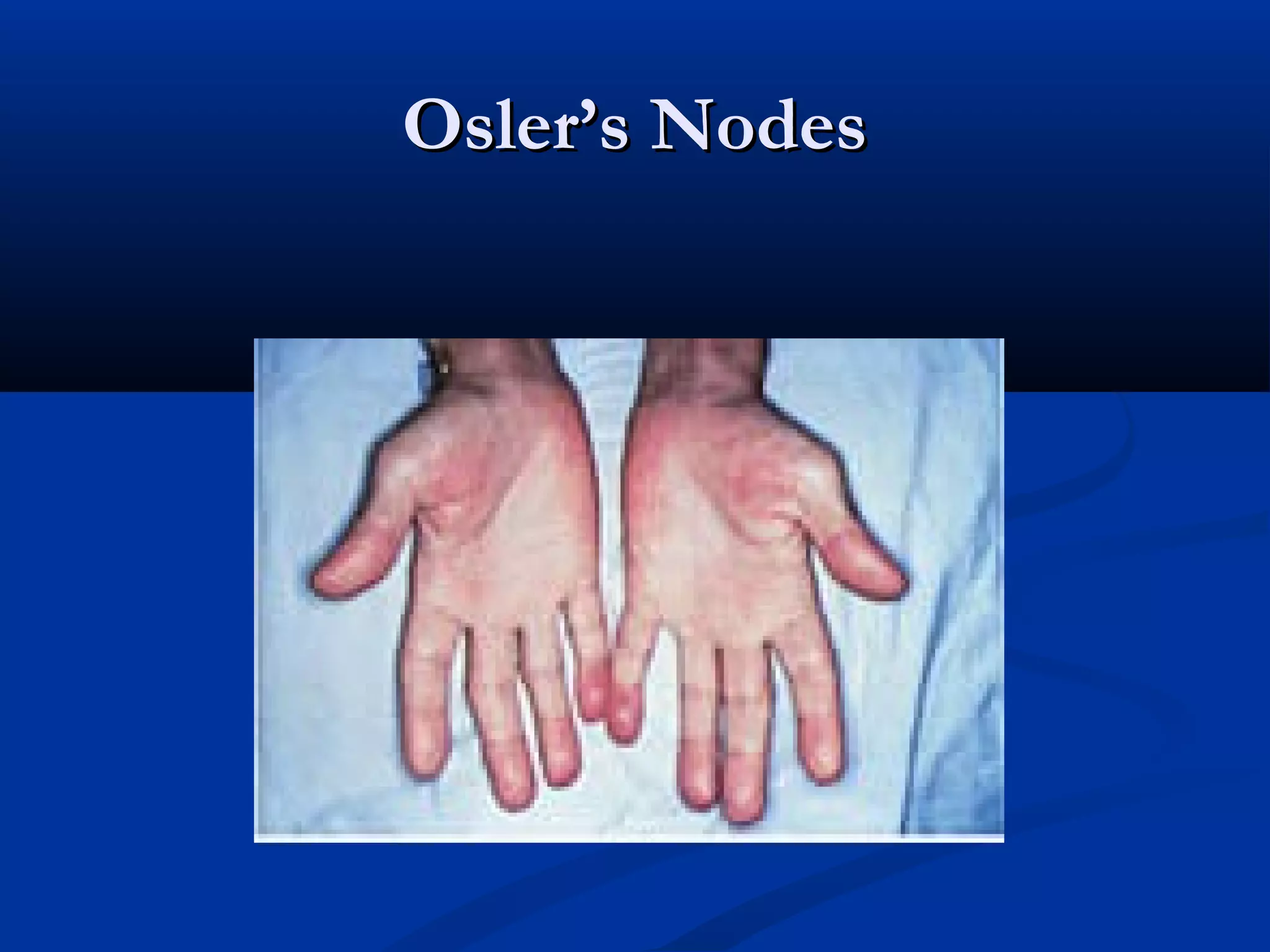 OOsslleerr’’ss NNooddeess 
 