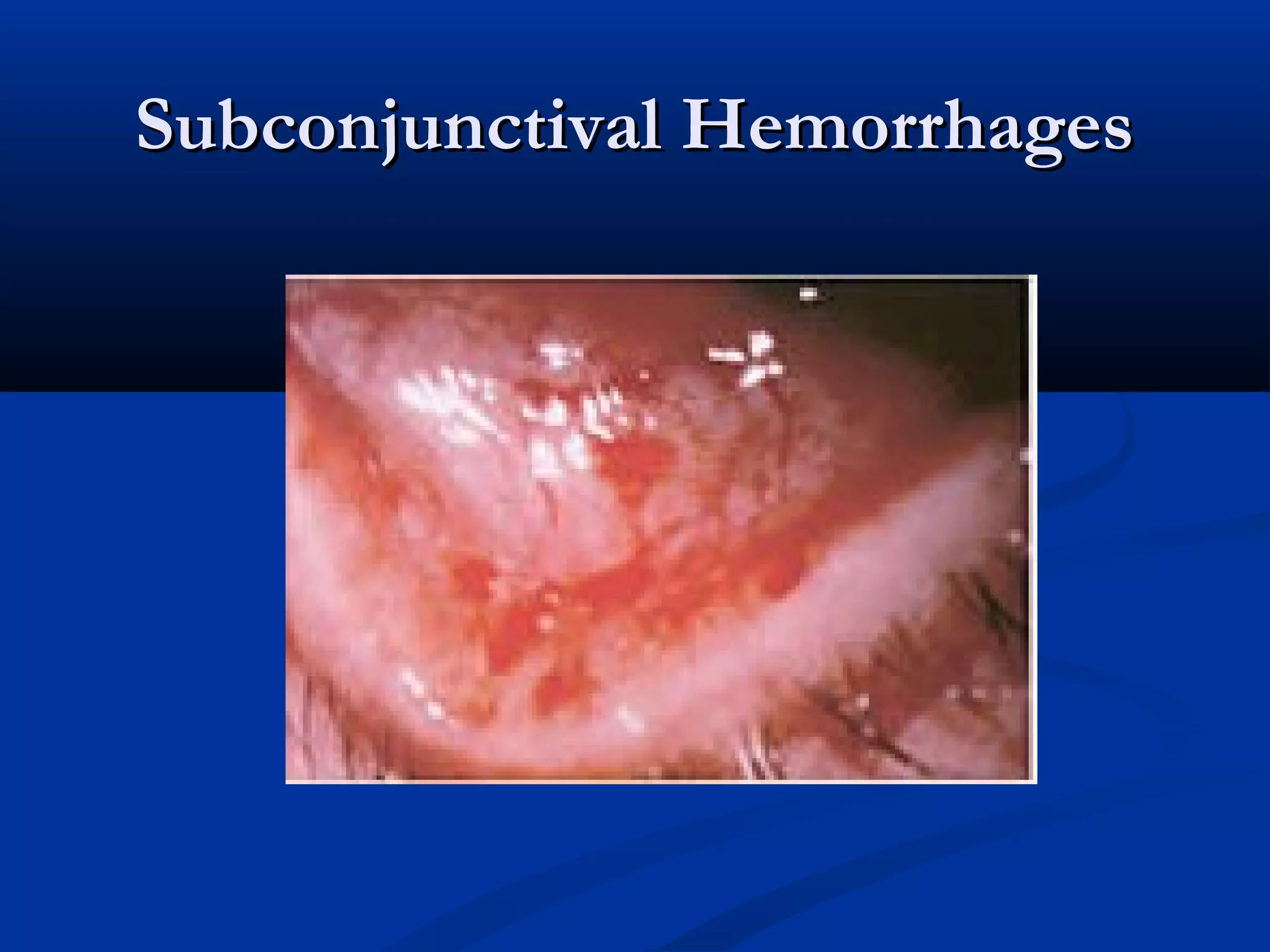 SSuubbccoonnjjuunnccttiivvaall HHeemmoorrrrhhaaggeess 
 