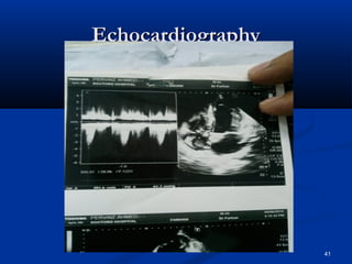 EEcchhooccaarrddiiooggrraapphhyy 
41 
 