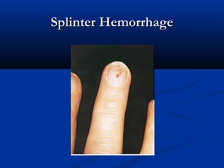 SSpplliinntteerr HHeemmoorrrrhhaaggee 
 