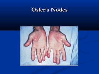 OOsslleerr’’ss NNooddeess 
 