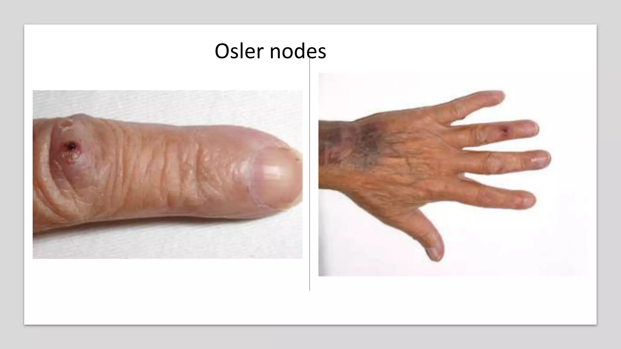 Infective endocarditis ESC guidelines Ahmed Yehia. MD | PPTX