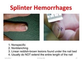 Splinter In Nail infectiveendocarditisnet-130621100221-phpapp01 (1).pdf