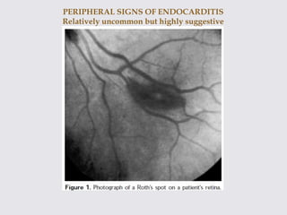 PERIPHERAL SIGNS OF ENDOCARDITIS
Relatively uncommon but highly suggestive
 