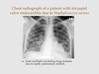  Note multiple cavitating lung nodules
due to septic pulmonary emboli.
Chest radiograph of a patient with tricuspid
valve endocarditis due to Staphylococcus aureus
 