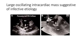 Large oscillating intracardiac mass suggestive
of infective etiology
 