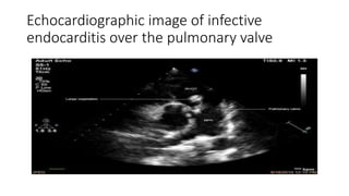 Echocardiographic image of infective
endocarditis over the pulmonary valve
 