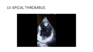 LV APICAL THROMBUS
 