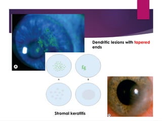 infective keratitis by Shazia khan. Pptx | PPTX