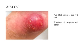 INFECTIVE SYNDROMES best best OF SKIN.pptx