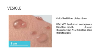 Vesication INFECTIVE SYNDROMES best best OF SKIN.pptx