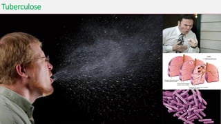 Tuberculose
• A tuberculose é uma das doenças infecciosas documentadas de mais
longa data e que continua a afligir a Humanidade nos dias atuais.
• Causada pelo Mycobacterium tuberculosis
• A tuberculose pulmonar é a forma mais frequente e generalizada da
doença. Porém, o bacilo da tuberculose pode afetar também outras
áreas do nosso organismo, como, por exemplo, laringe, ossos e
articulações, pele (lúpus vulgar), gânglios linfáticos, intestino e sistema
nervoso.
• A tuberculose miliar consiste num alastramento da infecção a diversas
partes do organismo, por via sanguínea.
 