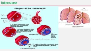 Tuberculose
• A infecção pelo M. tuberculosis se inicia quando o bacilo atinge
os alvéolos pulmonares.
• A resposta imunológica do organismo mata a maioria dos bacilos, levando à
formação de um granuloma. Os nódulos de tuberculose são pequenas lesões
que consistem em tecidos mortos de cor acinzentada contendo a bactéria da
tuberculose.
• Normalmente o sistema imunológico é capaz de conter a multiplicação do
bacilo, evitando sua disseminação em 90% dos casos.
• Cerca de 5% das pessoas infectadas vão desenvolver a doença nos dois
primeiros anos, e outras 5% vão desenvolvê-la ainda mais tarde.
 