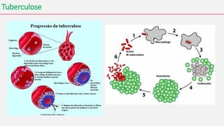 Tuberculose
 