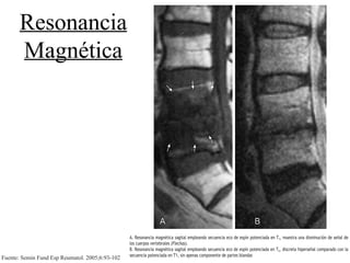 Resonancia
Magnética

Fuente: Semin Fund Esp Reumatol. 2005;6:93-102

A. Resonancia magnética sagital empleando secuencia eco de espín potenciada en T1, muestra una disminución de señal de
los cuerpos vertebrales (Flechas).
B. Resonancia magnética sagital empleando secuencia eco de espín potenciada en T2, discreta hiperseñal comparado con la
secuencia potenciada en T1, sin apenas componente de partes blandas

 
