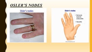 Endocarditis ( Inflammatory disease of the Heart | PPTX