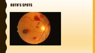 Inverse Roth Spot Endocarditis ( Inflammatory disease of the Heart | PPTX