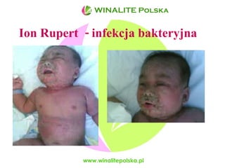 Ion Rupert  - infekcja bakteryjna www.winalitepolska.pl WINALITE Polska 