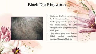 Black Dot Ringworm
• Disebabkan Trichophyton tonsurans
dan Trichophyton violaceum
• Rambut yang terinfeksi patah, tepat
pada muara folikel, dan yang
tertinggal adalah ujung rambut yang
penuh spora
• Ujung rambut yang hitam didalam
folikel rambut memberikan
gambaran khas yaitu black dot
 