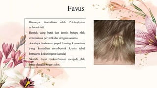 Favus
• Biasanya disebabkan oleh Trichophyton
schoenleinii
• Bentuk yang berat dan kronis berupa plak
eritematosa perifolikular dengan skuama
• Awalnya berbentuk papul kuning kemerahan
yang kemudian membentuk krusta tebal
berwarna kekuningan (skutula)
• Skutula dapat berkonfluensi menjadi plak
besar dengan mousy odor.
 