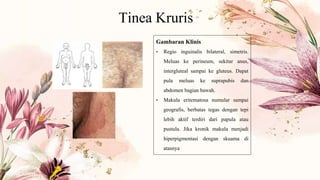 Tinea Kruris
Gambaran Klinis
• Regio inguinalis bilateral, simetris.
Meluas ke perineum, sekitar anus,
intergluteal sampai ke gluteus. Dapat
pula meluas ke suprapubis dan
abdomen bagian bawah.
• Makula eritematosa numular sampai
geografis, berbatas tegas dengan tepi
lebih aktif terdiri dari papula atau
pustula. Jika kronik makula menjadi
hiperpigmentasi dengan skuama di
atasnya
 