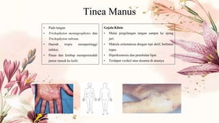 Tinea Manus
• Pada tangan
• Trichophyton mentagrophytes dan
Trichophyton rubrum.
• Daerah tropis mempertinggi
infeksi.
• Panas dan lembap mempermudah
jamur masuk ke kulit.
Gejala Klinis
• Mulai pergelangan tangan sampai ke ujung
jari.
• Makula eritematosa dengan tepi aktif, berbatas
tegas.
• Hiperkeratosis dan penebalan lipat
• Terdapat vesikel atau skuama di atasnya
 