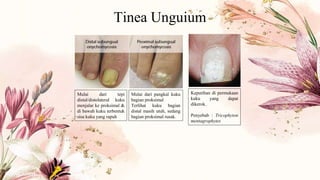 Tinea Unguium
Mulai dari tepi
distal/distolateral kuku
menjalar ke proksimal &
di bawah kuku terbentuk
sisa kuku yang rapuh
Mulai dari pangkal kuku
bagian proksimal
Terlihat kuku bagian
distal masih utuh, sedang
bagian proksimal rusak.
Keputihan di permukaan
kuku yang dapat
dikerok.
Penyebab : Tricophyton
mentagrophytes
 