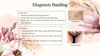 Tinea korporis:
- Dermatitis seboroik: skuama kuning berminyak
- Psoriasis: lebih merah, skuama lebih banyak, ada lekukan kuku
- Pitirasis rosea: ada lesi pertama herald patch (bulat oval, bersisik dan
sedikit menonjol)
Herald patch
Tinea kruris:
- Psoriasis pada paha: lebih merah, skuama lebih banyak, lamellar,
ada lesi di tempat lain
- Eritrasma: lesi sama eritema dan skuama, lampu wood: merah
coral
- Kandidosis pada lipat paha: konfigurasi hen and chicken, basah
berkrusta.
Eritrasma di paha
Diagnosis Banding
 