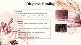 Diagnosis Banding
Tinea barbae:
- Sikosis barbae: folikulitis di area jenggot disebabkan oleh
piokokus, dibedakan dengan pemeriksaan sediaan langsung
Tinea kapitis:
- Dermatitis seboroik: lesi kulit simetris, skuama kuning
berminyak
- Psoriasis: biasanya disertai dengan kelainan kulit di tempat
lain
- Impetigo yang menyertai pediculosis kapitis: kotor
berkrusta, tidak ada rambut yang putus
- Alopecia areata: tidak terdapat skuama
Sikosis barbae
Pediculosis kapitis
 