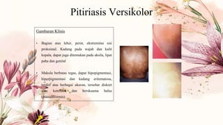 Pitiriasis Versikolor
Gambaran Klinis
• Bagian atas leher, perut, ekstremitas sisi
proksimal. Kadang pada wajah dan kulit
kepala, dapat juga ditemukan pada aksila, lipat
paha dan genital
• Makula berbatas tegas, dapat hipopigmentasi,
hiperpigmentasi dan kadang eritematosa,
terdiri atas berbagai ukuran, tersebar diskret
atau konfluen dan berskuama halus
(pitiriasiformis)
 