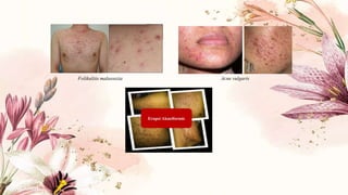 Folikulitis malassezia Acne vulgaris
 