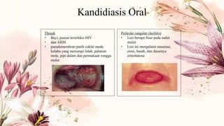 Kandidiasis Oral
Thrush
• Bayi, pasien terinfeksi HIV
• dan AIDS
• pseudomembran putih coklat muda
kelabu yang menutupi lidah, palatum
mole, pipi dalam dan permukaan rongga
mulut
Perleche (angular cheilitis)
• Lesi berupa fisur pada sudut
mulut
• Lesi ini mengalami maserasi,
erosi, basah, dan dasarnya
eritematosa
 