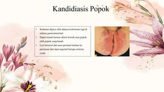 Kandidiasis Popok
• Kelainan dipicu oleh adanya kolonisasi ragi di
traktus gastrointestinal
• Dapat terjadi karena oklusi kronik area popok
oleh popok yang basah
• Lesi berawal dari area perianal meluas ke
perineum dan lipat inguinal berupa eritema
cerah
 