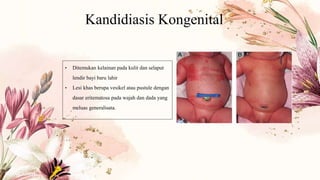 Kandidiasis Kongenital
• Ditemukan kelainan pada kulit dan selaput
lendir bayi baru lahir
• Lesi khas berupa vesikel atau pustule dengan
dasar eritematosa pada wajah dan dada yang
meluas generalisata.
 