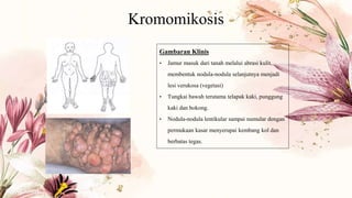 Kromomikosis
Gambaran Klinis
• Jamur masuk dari tanah melalui abrasi kulit,
membentuk nodula-nodula selanjutnya menjadi
lesi verukosa (vegetasi)
• Tungkai bawah terutama telapak kaki, punggung
kaki dan bokong.
• Nodula-nodula lentikular sampai numular dengan
permukaan kasar menyerupai kembang kol dan
berbatas tegas.
 
