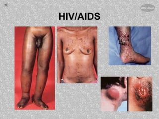 HIV/AIDS
IMS Umum
 