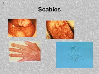 Scabies
 