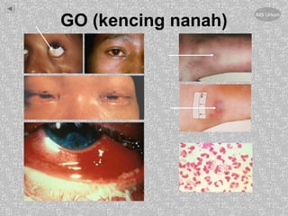 GO (kencing nanah)
IMS Umum
 