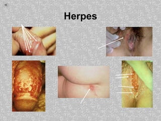 Herpes
 