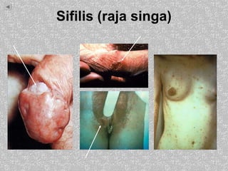 Sifilis (raja singa)
 