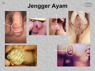 Jengger Ayam IMS Umum
 