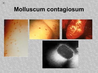 Molluscum contagiosum
 
