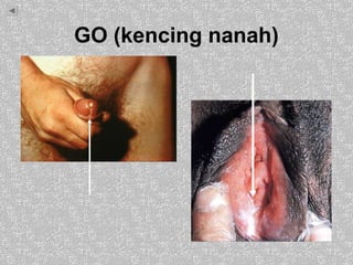 GO (kencing nanah)
 