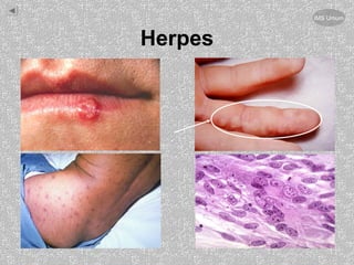 Herpes
IMS Umum
 