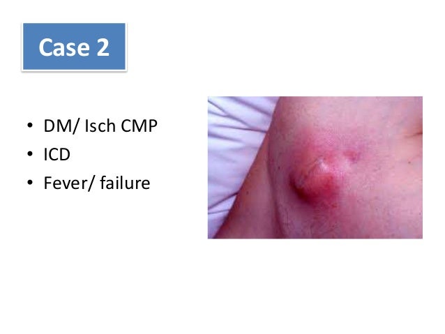 icd 10 code for hematuria icd 10 code for hematuria