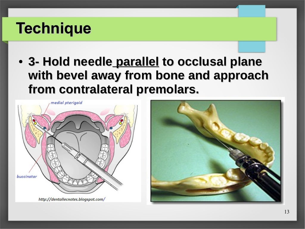 Inferior alveolar nerve block